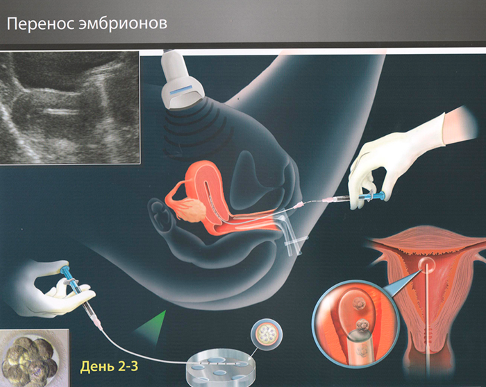 Схема переноса эмбрионов при ЭКО