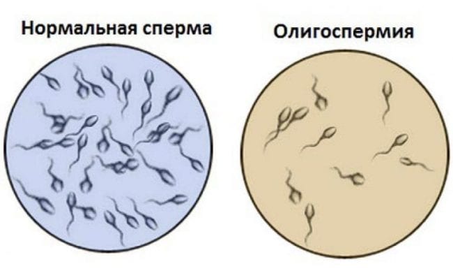 Олигоспермия у мужчин